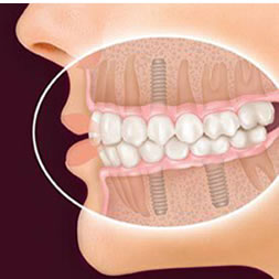 Dental-Implants-Ahmedabad