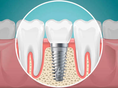 Dental Implant in Ahmedabad